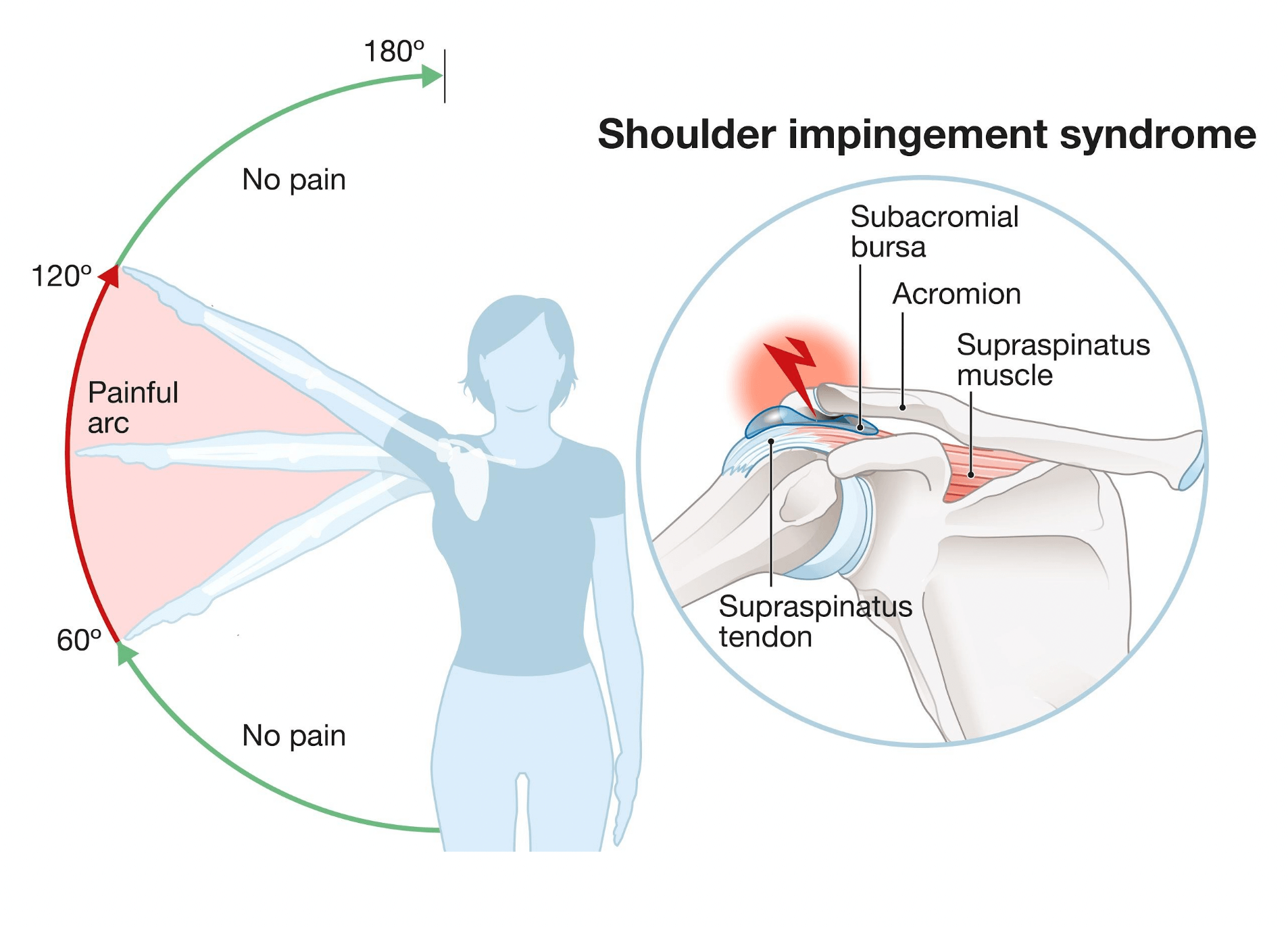 Impingement syndrom